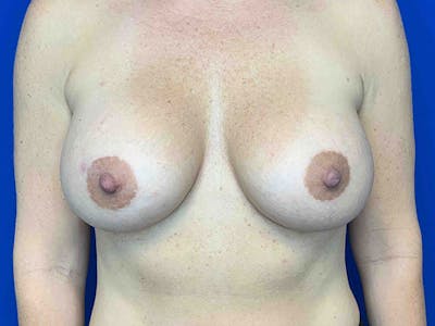 Breast Augmentation Before & After Gallery - Patient 8375941 - Image 2