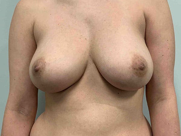 Breast Augmentation Before & After Gallery - Patient 8375972 - Image 1