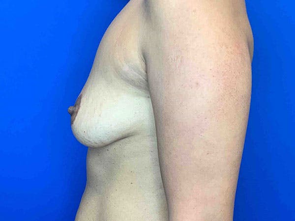 Breast Augmentation Before & After Gallery - Patient 8375976 - Image 3