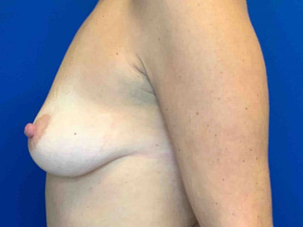 Breast Augmentation Before & After Gallery - Patient 8376013 - Image 3