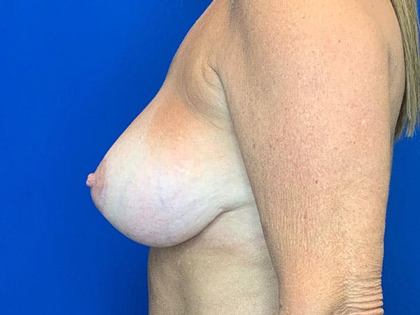 Mastopexy Before & After Gallery - Patient 8376017 - Image 4