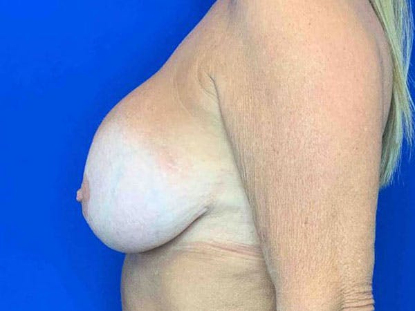 Mastopexy Before & After Gallery - Patient 8376017 - Image 3