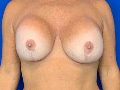 Mastopexy Before & After Gallery - Patient 8376017 - Image 1