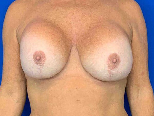 Mastopexy Before & After Gallery - Patient 8376017 - Image 1