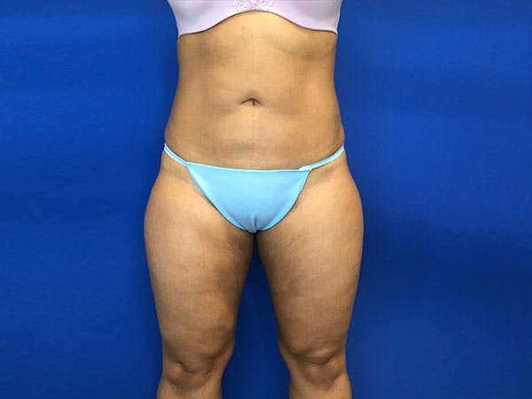 Liposuction Before & After Gallery - Patient 8376496 - Image 2
