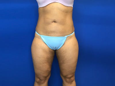Liposuction Gallery - Patient 8376496 - Image 2