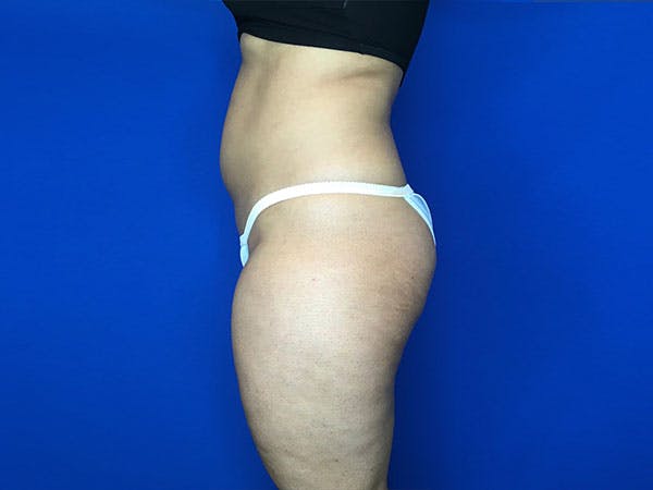 Liposuction Before & After Gallery - Patient 8376496 - Image 3
