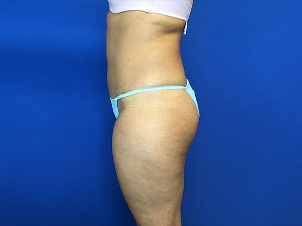 Liposuction Gallery - Patient 8376496 - Image 4