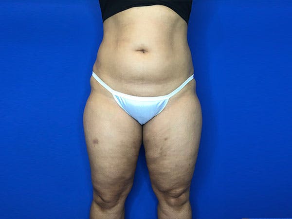 Liposuction Before & After Gallery - Patient 8376496 - Image 1