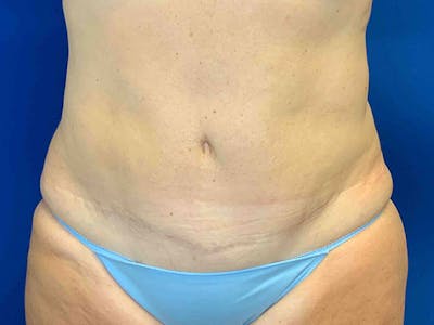 Liposuction Before & After Gallery - Patient 8376513 - Image 2
