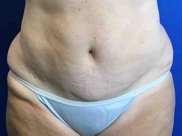 Liposuction Before & After Gallery - Patient 8376513 - Image 1