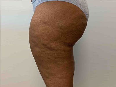 Liposuction Before & After Gallery - Patient 8376544 - Image 4