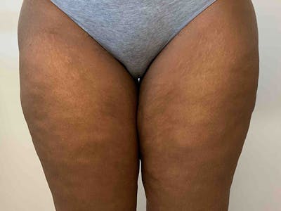 Liposuction Before & After Gallery - Patient 8376544 - Image 2