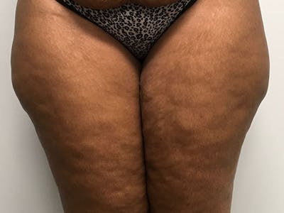 Liposuction Before & After Gallery - Patient 8376544 - Image 1