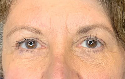Brow Lift Before & After Gallery - Patient 9605607 - Image 2