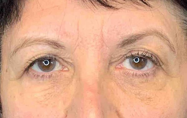 Brow Lift Before & After Gallery - Patient 9605607 - Image 1