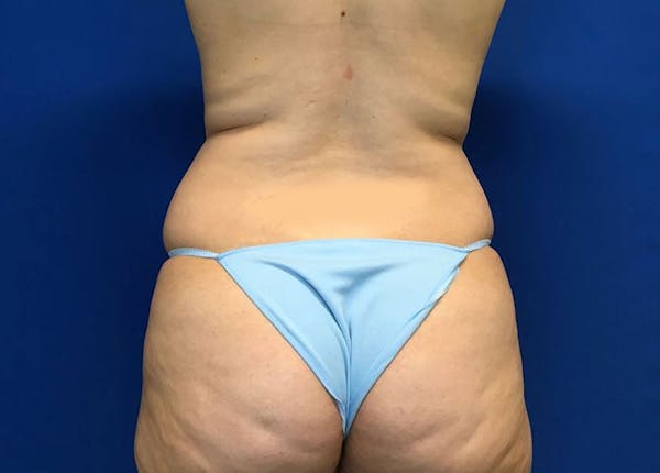 Liposuction Before & After Gallery - Patient 10945505 - Image 7