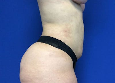 Liposuction Before & After Gallery - Patient 10945505 - Image 4