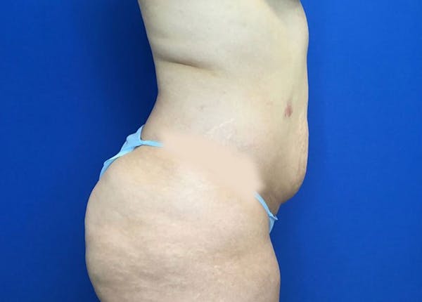 Liposuction Before & After Gallery - Patient 10945505 - Image 3