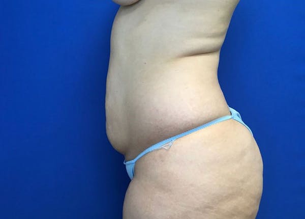 Liposuction Before & After Gallery - Patient 10945505 - Image 5