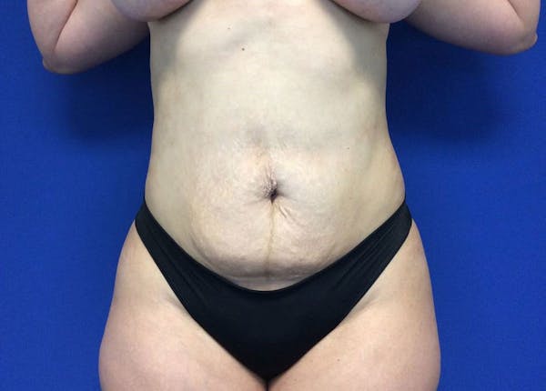 Liposuction Before & After Gallery - Patient 10945505 - Image 2