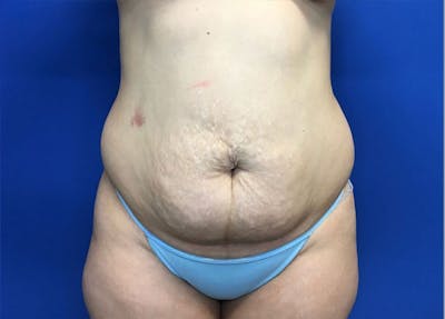 Liposuction Before & After Gallery - Patient 10945505 - Image 1