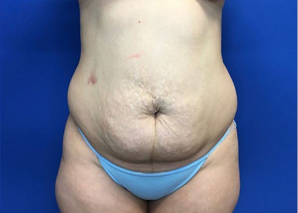 Liposuction Before & After Gallery - Patient 10945505 - Image 1