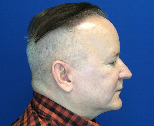 Hair Restoration Before & After Gallery - Patient 149341895 - Image 6