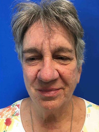 Face Lift Before & After Gallery - Patient 11269970 - Image 1
