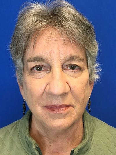 Face Lift Before & After Gallery - Patient 11269970 - Image 2