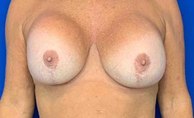 Breast Implant Removal and Replacement Before & After Gallery - Patient 21143606 - Image 1