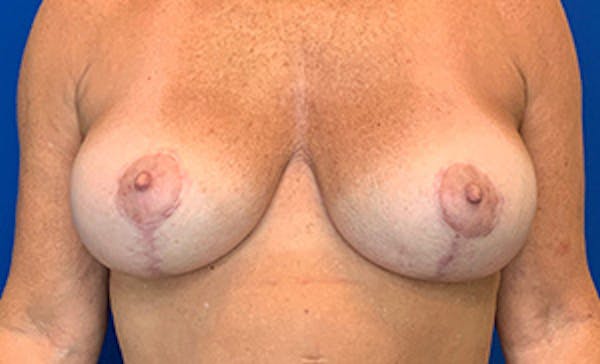 Breast Implant Removal and Replacement Before & After Gallery - Patient 21143606 - Image 2