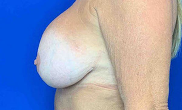 Breast Implant Removal and Replacement Before & After Gallery - Patient 21143606 - Image 3
