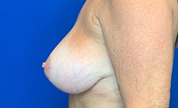 Breast Implant Removal and Replacement Before & After Gallery - Patient 21143606 - Image 4
