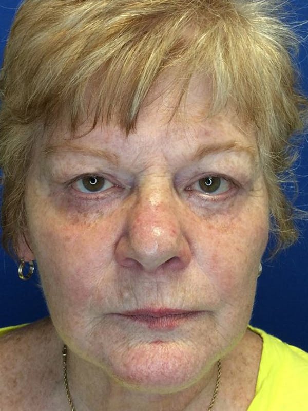 Face Lift Before & After Gallery - Patient 21368159 - Image 3