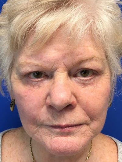 Face Lift Before & After Gallery - Patient 21368159 - Image 2