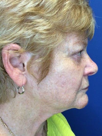 Face Lift Before & After Gallery - Patient 21368159 - Image 1