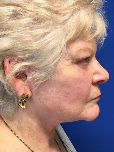 Face Lift Before & After Gallery - Patient 21368159 - Image 4