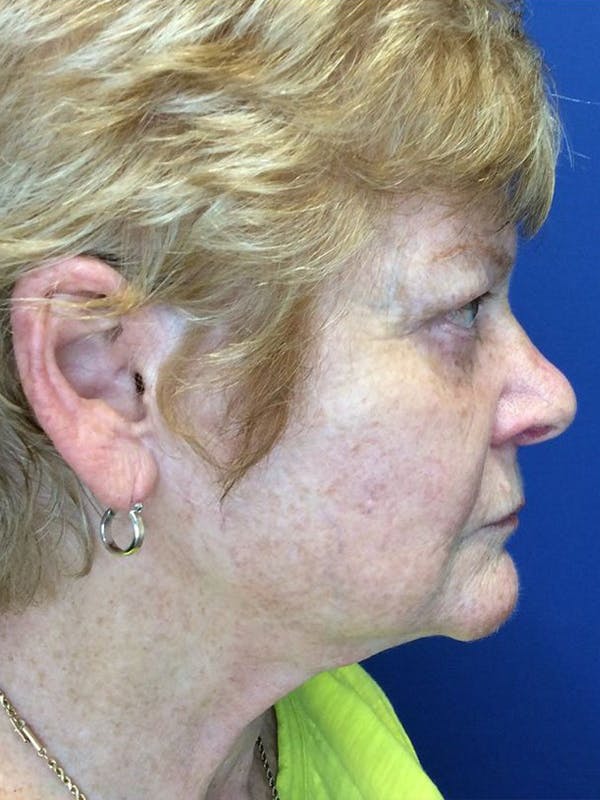 Neck Lift Before & After Gallery - Patient 21368161 - Image 3