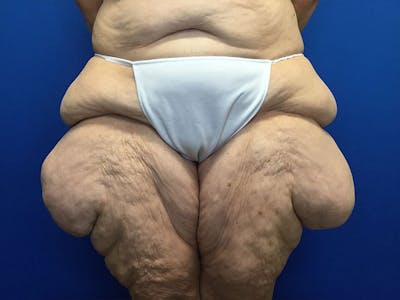Thigh Lift Before & After Gallery - Patient 24963363 - Image 1