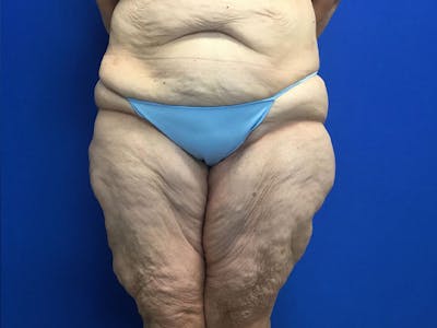 Thigh Lift Before & After Gallery - Patient 24963363 - Image 2