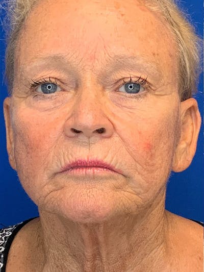 Face Lift Before & After Gallery - Patient 25130883 - Image 1