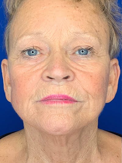 Face Lift Before & After Gallery - Patient 25130883 - Image 4