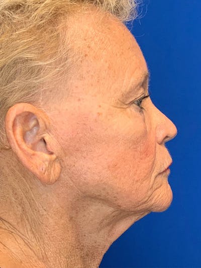 Face Lift Before & After Gallery - Patient 25130883 - Image 1