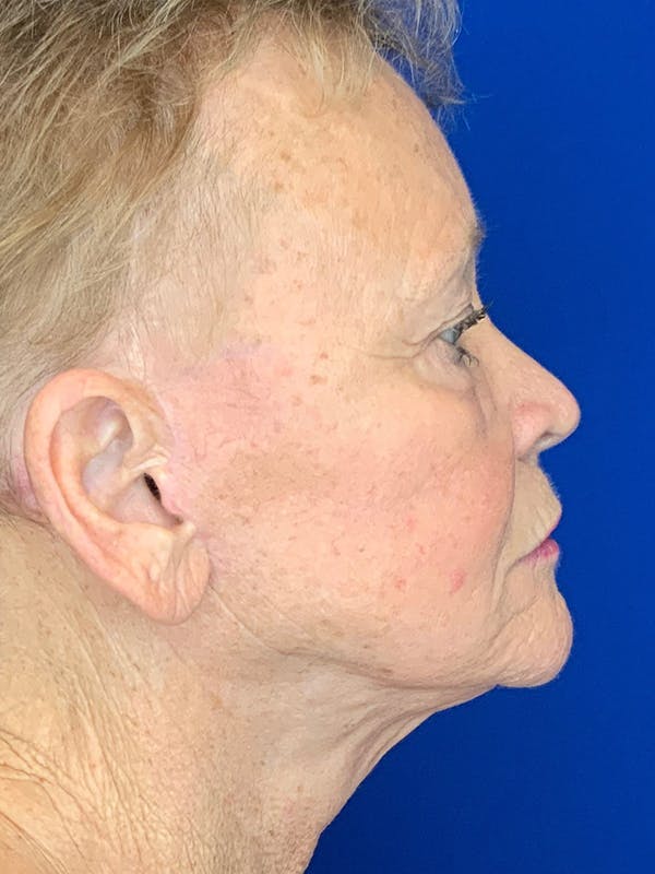Face Lift Before & After Gallery - Patient 25130883 - Image 2