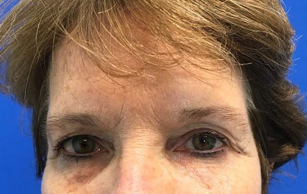 Brow Lift Before & After Gallery - Patient 25456235 - Image 1