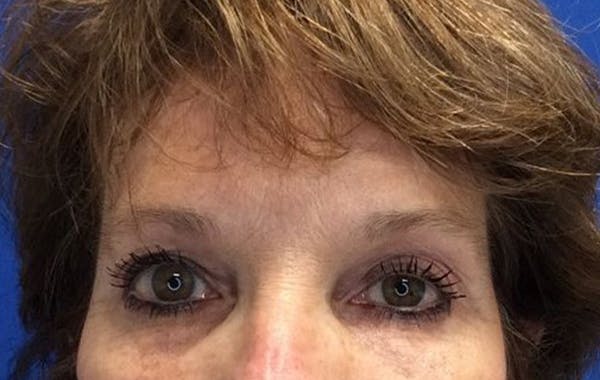 Brow Lift Before & After Gallery - Patient 25456235 - Image 2