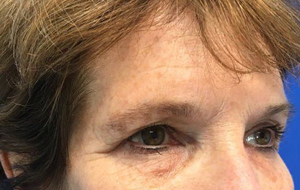 Brow Lift Before & After Gallery - Patient 25456235 - Image 3