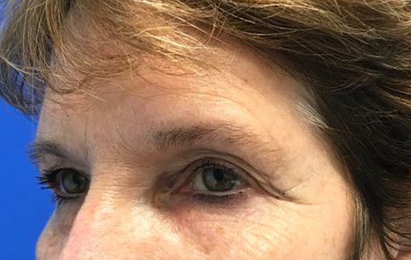 Brow Lift Before & After Gallery - Patient 25456235 - Image 5