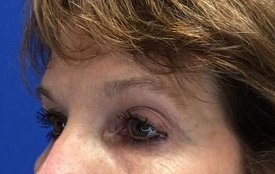 Brow Lift Before & After Gallery - Patient 25456235 - Image 6